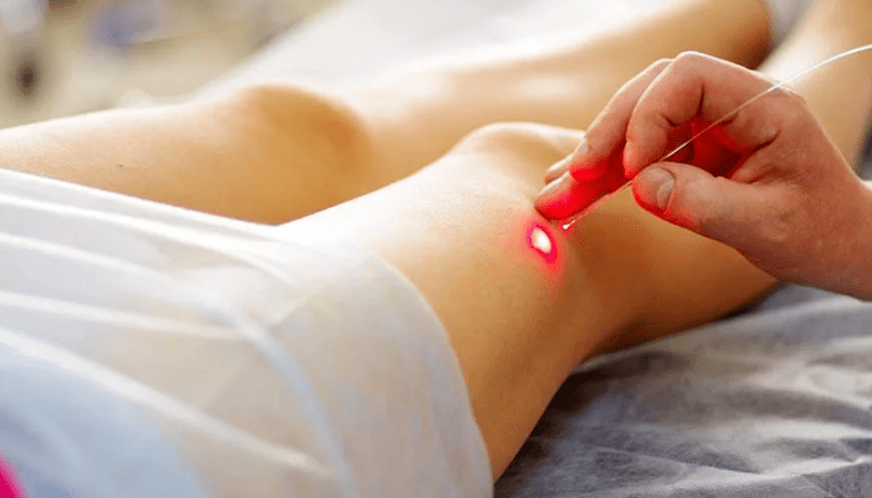 Veenilaiendite laserhüübimine